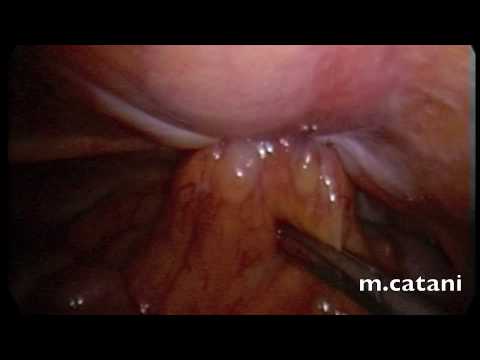 Colore della calce per le articolazioni Trattamento infiammazione articolare