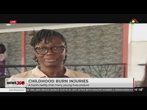 Childhood burn injuries: Shedding light on the harsh reality many young lives endure
