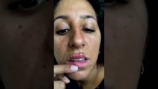 Cystic acne and blackheads removal - Newest pimple pops for 2022