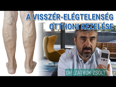 Videó a visszér lézeres műtétéről