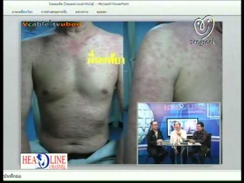 ครีมที่มีคราบจุลินทรีย์โรคสะเก็ดเงิน ผิวหนังและเล็บโรคสะเก็ดเงิน