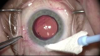 Eye Surgeons of Indiana