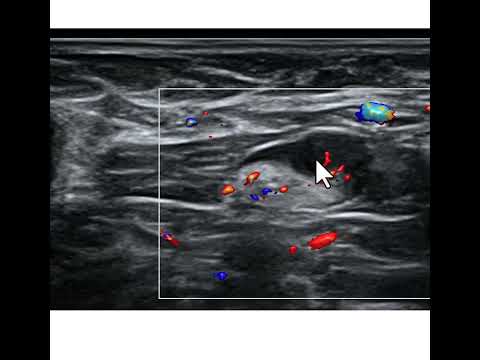 Sonoanatomia da metástase linfonodal