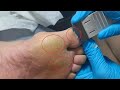 Three big Callus removal from feet. Dead skin removal and Cracked heels treatment. Foot care.