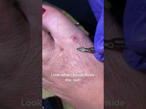Is this a foreign body?