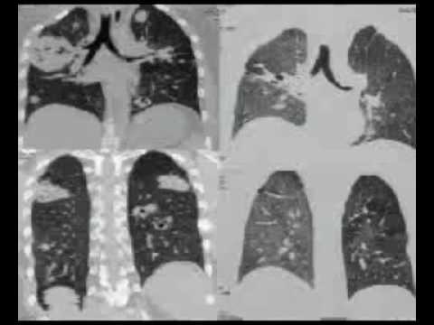 CCR Pulmonary Medicine 20 09 2016