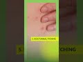10 Early Signs Of Bed Bugs Bites Bedbugs Bedbugsbites Bedbugssigns