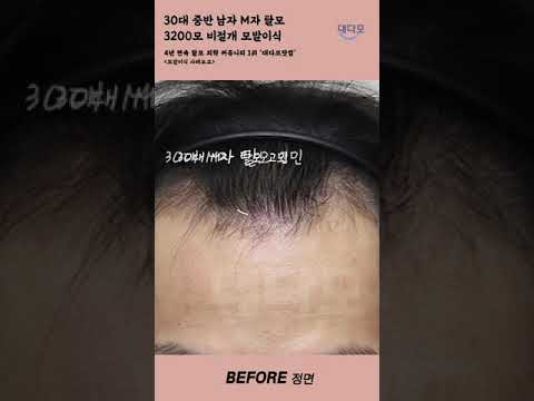 30岁中期 男士M型脱发, 非切开毛发移植 3200发 1年后期 Before & After [#shorts]