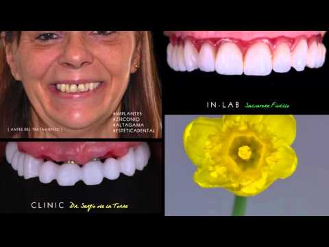 Orión Dental - Implantes - Maite - Coronas Zirconio Porcelana - Dr. Sergio de la Torre
