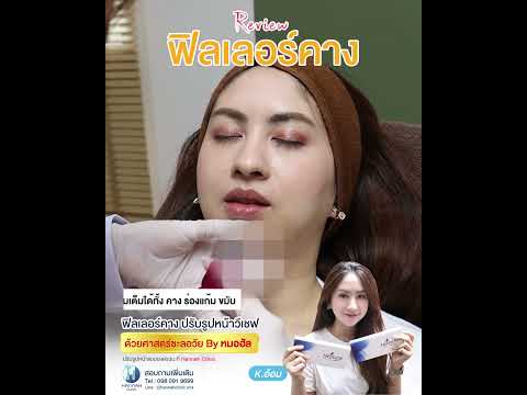 รีวิวหัตถการโปรแกรมฟิลเลอร์คาง
