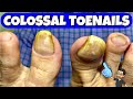 HUGE TOENAILS DEBRIDEMENT LONG TIME NO SEE THE NIPPER