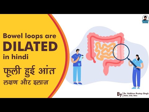 Bowel Loops are Dilated in Hindi || Dilated Bowel: Symptoms and Treatment Information