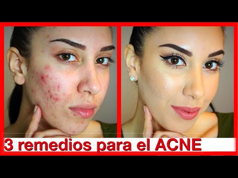 Remedios caseros para el acné