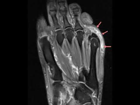 Pressure lesion about 5th MTP joint