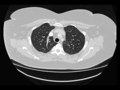 Lobo pulmonar ázigos