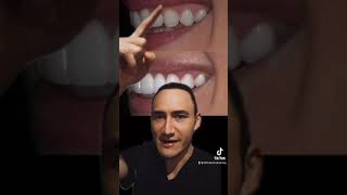 ¿Por qué estoy en contra de las carillas dentales #shorts