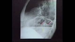 Plain film, CT Assess OF PL DISEASE