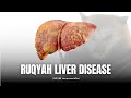 RUQYAH LIVER DISEASE