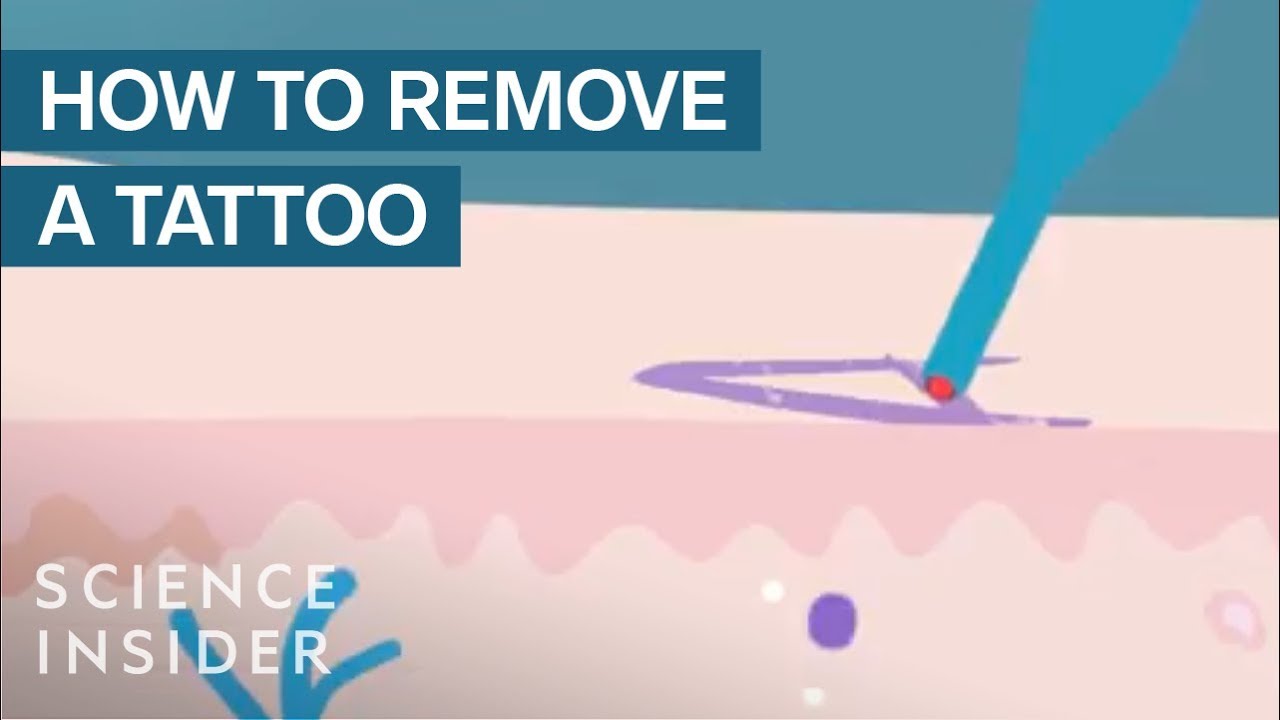 What Happens When You Get A Tattoo Removed