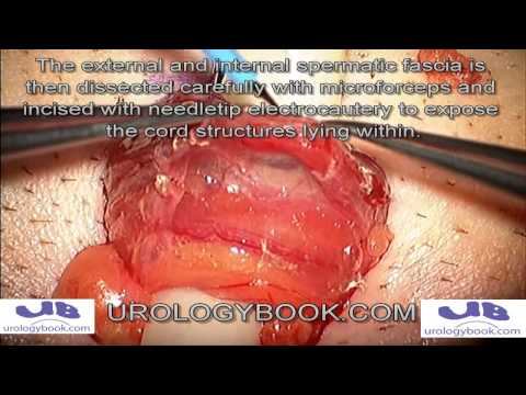 Warikocelektomia metodą mikrochirurgiczną