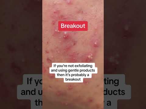 ARE YOU BREAKING OUT OR PURGING #shorts