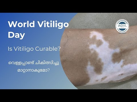 Is vitiligo curable?| വെള്ളപ്പാണ്ട് ചികിത്സിച്ചു മ