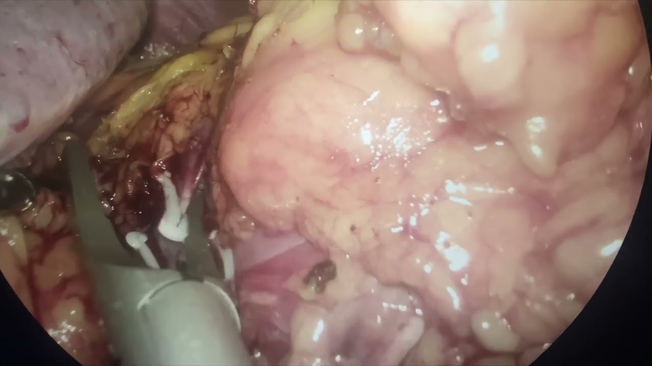 Laparoscopic Nephrectomy