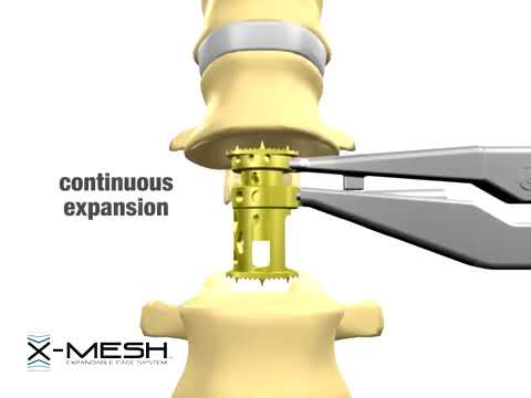 DepuySynthes (Depuy): X Mesh Expandable Cage