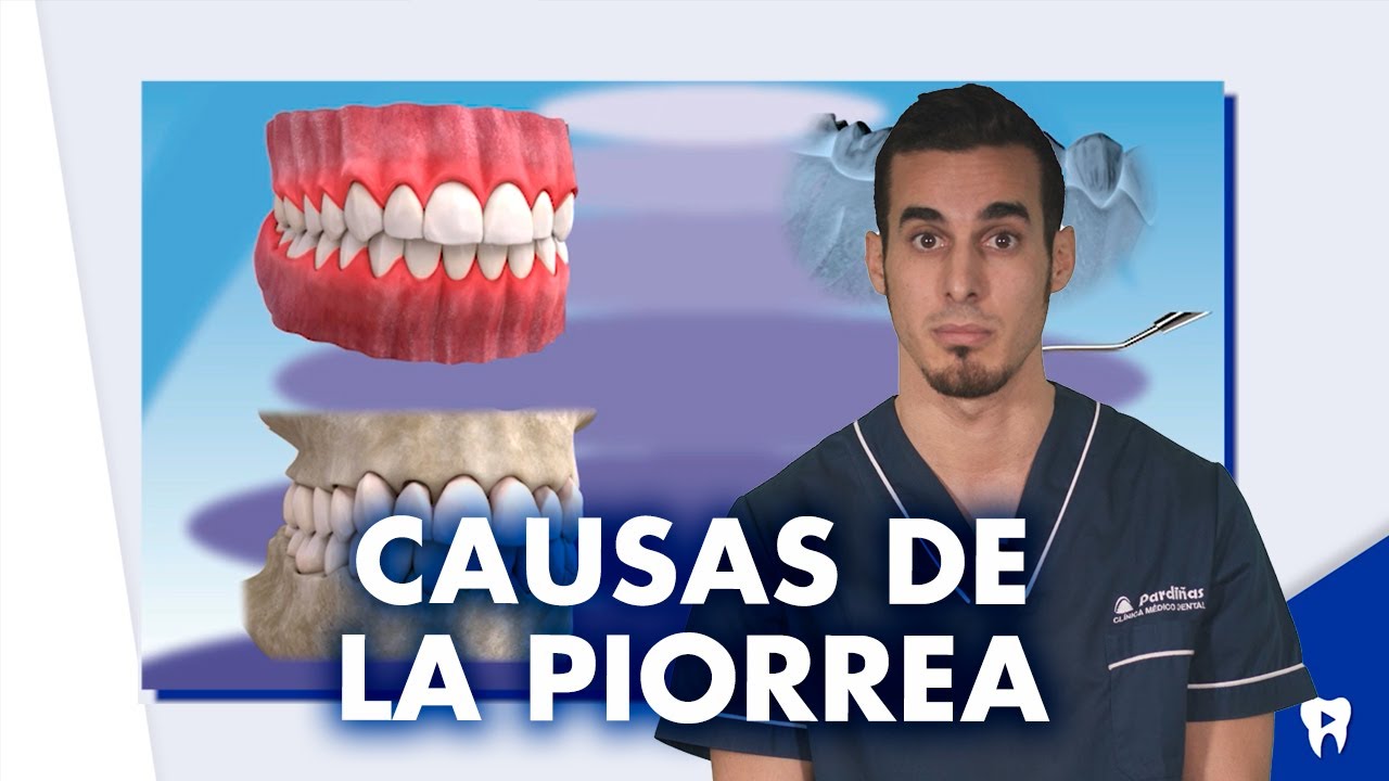 Diferencias entre la PERIODONTITIS y la GINGIVITIS | #Shorts
