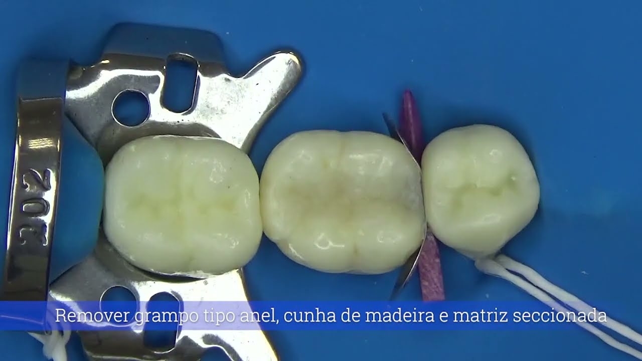 Restauração em resina composta