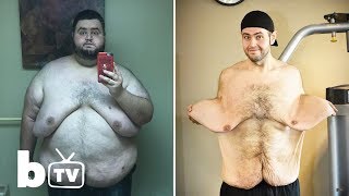 My 300lbs Weight Loss Left Me With 13lbs Of Loose Skin