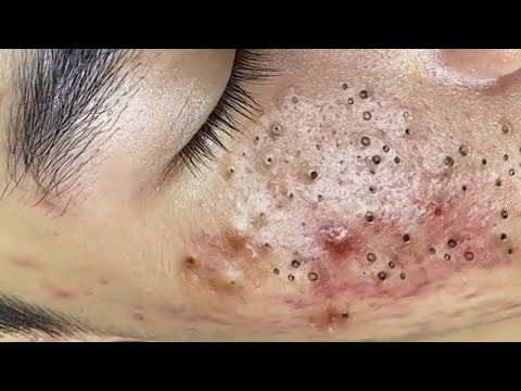 𝑪𝒚𝒔𝒕𝒊𝒄 𝑨𝒄𝒏𝒆 𝑹𝒆𝒎𝒐𝒗𝒂𝒍 & 𝑰𝒏𝒇𝒍𝒂𝒎𝒎𝒂𝒕𝒐𝒓𝒚 𝑨𝒄𝒏𝒆 #𝟗𝟎𝟎𝟐𝟑