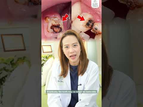 Neglecting root canal treatment can possibly lead to death