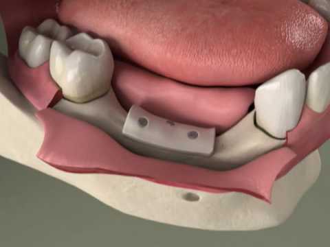 Dental Implants - Bone Grafting - Ridge Preservation in Denville, NJ