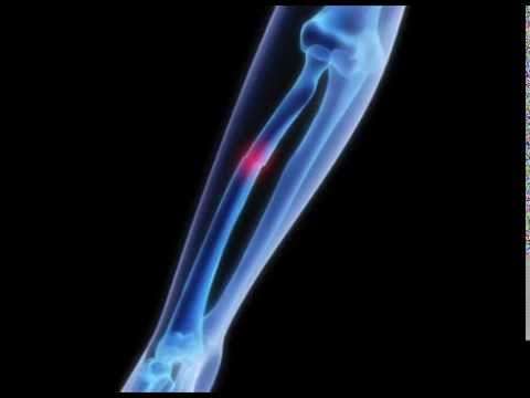 Bone Breaking - Sound Effect | Fracture Sfx | HD
