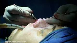 Dr. Nassif’s Closed Rhinoplasty How To – Rim Graft