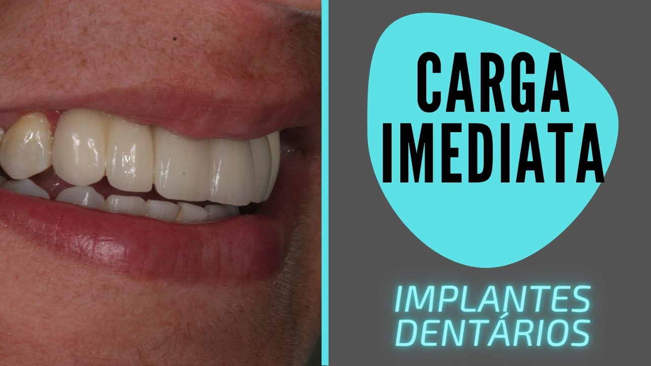 CARGA IMEDIATA EM IMPLANTES DENTÁRIOS - COMO FUNCIONA?