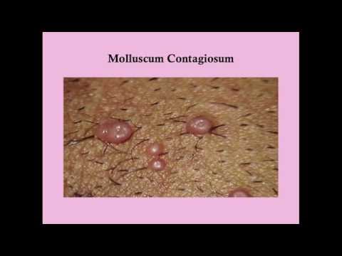 könny helminthiasisok hpv vírus nemi szemölcsök kezelése
