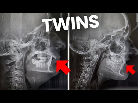 Overbite (overjet) Correction for TWINS Without Surgery!