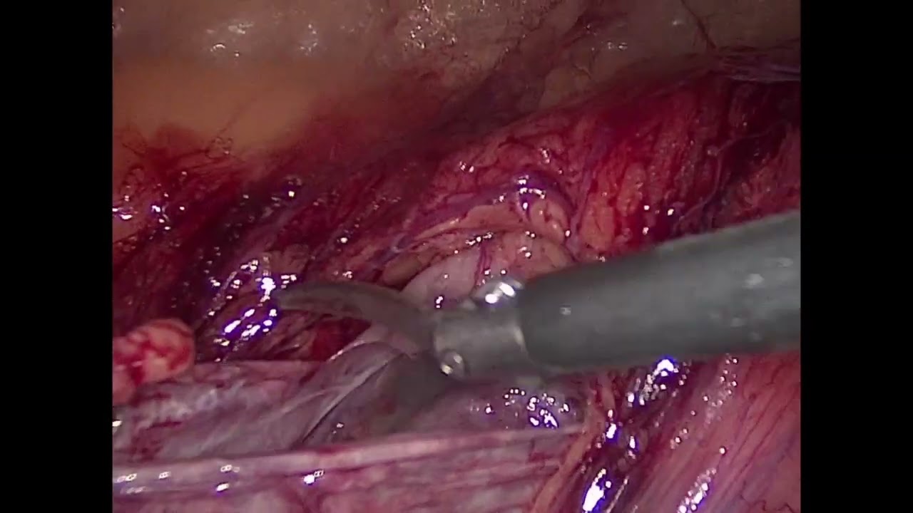 Laparoscopic Kidney Cyst Decortication