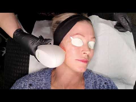 Venus Versa IPL landscape - Changes Clinic