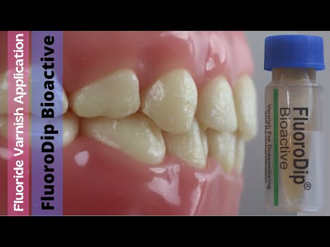 Fluoride Varnish Application 