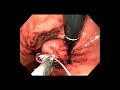 Endoscopic full thickness resection of a GIST
