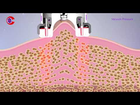 How Vacuum RF Fat Reduction Skin Tightening Treatment Work|Slimming Lymphatic Drainage Machine