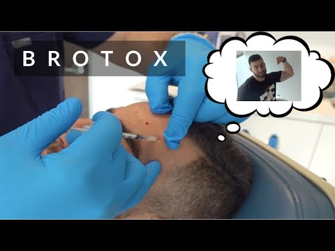 BROTOX - MALE BOTOX INJECTIONS FOR FOREHEAD & FROWN LINES