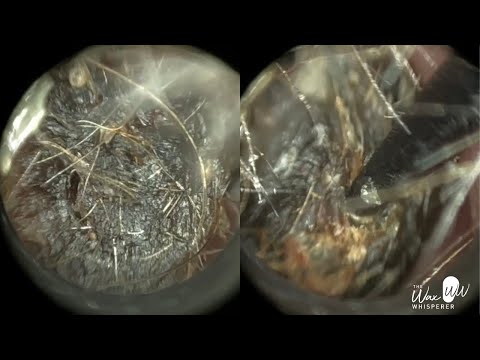 189 - Rock Solid Ear Wax Plug Extracted with Rai Ear Pick & WAXscope®️