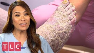 Dr. Lee Meets a Man Covered in Dry Scaly Skin | Dr. Pimple Popper