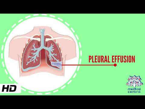 Pleural Effusion, Causes, Signs and Symptoms, Diagnosis and Treatment.