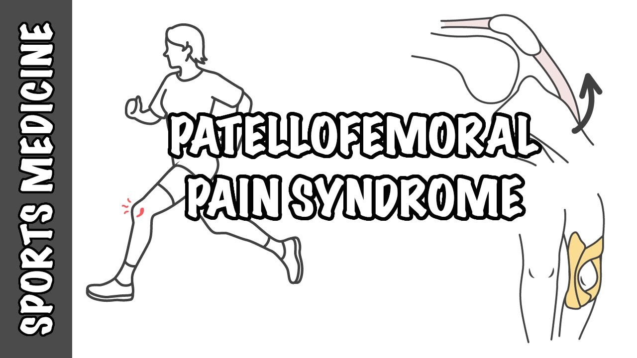 Patellofemoral Pain Syndrome - runner's knee