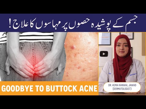 How To Treat Buttock Acne - Treatment Of Pimples On Buttocks - Reason For Blackheads - Treatment ...